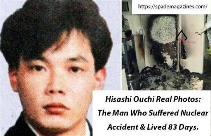 Mysterious 83 Days: Disturbing Photos Of Hisashi Ouchi's Tragic Accident