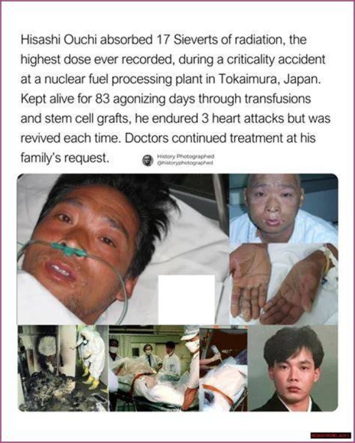 Tragic Tale Of Hisashi Ouchi: Radiation Poisoning's Gruesome Toll