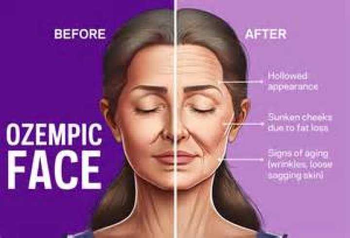 Understanding The Compatibility Of Ozempic And Lupus: Can You Take Ozempic With Lupus?