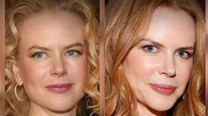 Unveiling The Transformation: Nicole Kidman Plastic Surgery Before After